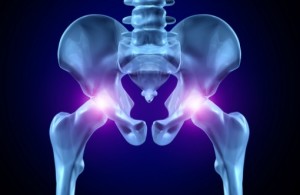 Metal on metal hip replacement lawsuit attorney