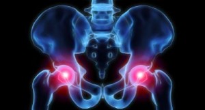 Wright medical technology metal hip replacement lawsuit help